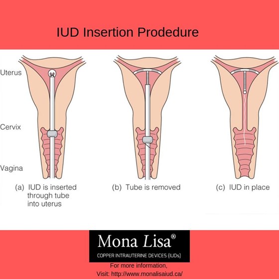 Copper IUD: Mona Lisa® IUD Insertion Procedure